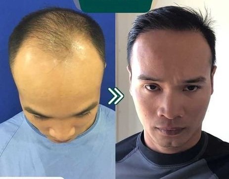 نتائج زيت الأعشاب 108